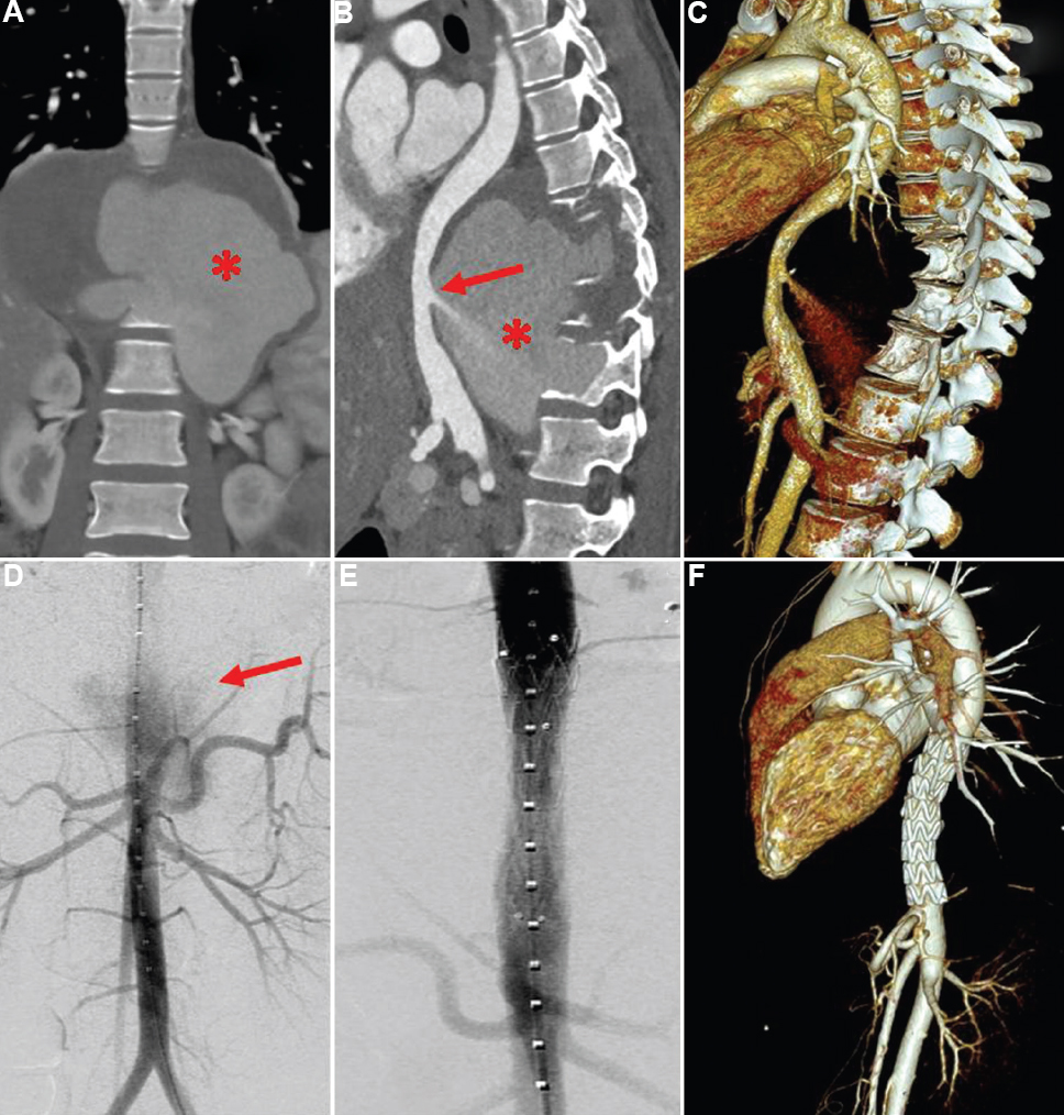 Computed tomography (CT) showing abdominal aortic rupture into the tubercular paravertebral abscess. (A) Coronal view. (B) Sagittal view. (C) Volume-rendered CT reconstructions showing active contrast extravasation from the posterior wall of juxtadiaphragmatic aorta into the large paravertebral abscess (red arrow). Hyperdense contents (blood) noted in the abscess (asterisks). (D) Digital subtraction angiogram revealing active contrast extravasation from the abdominal aorta (red arrow). (E) Abdominal aortic stent graft was deployed with no contrast leak. (F) Follow up computed tomography after one month showing aortic stent graft with no leak.